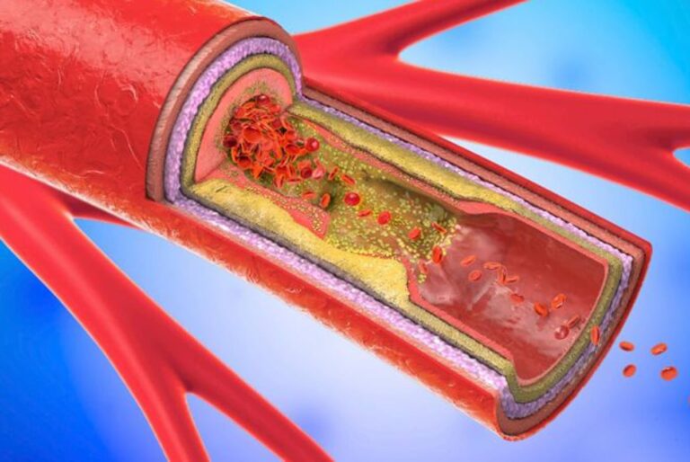 Un estudio muestra que la aterosclerosis afecta de forma silente a un gran porcentaje de personas sanas